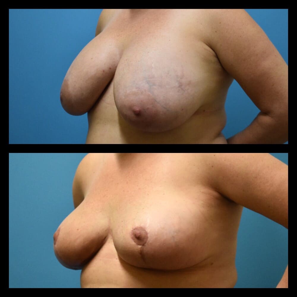 Zeiderman before and after breast lift procedure