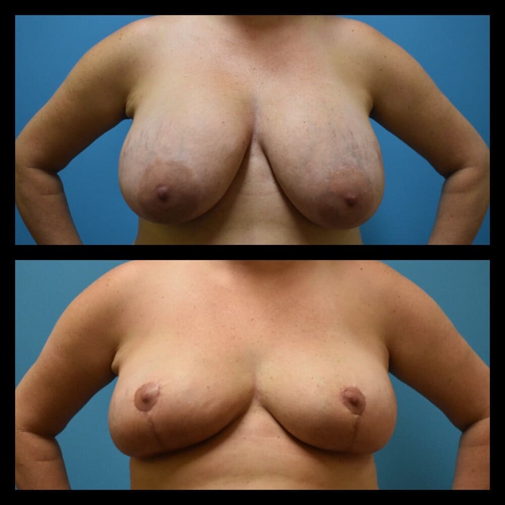 Zeiderman before and after breast lift procedure