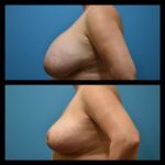 Thumbnail of http://Zeiderman%20before%20and%20after%20breast%20lift%20procedure