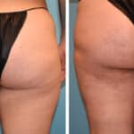 Thumbnail of http://Zeiderman%20before%20and%20after%20thigh%20lift%20procedure