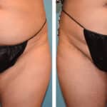 Thumbnail of http://Zeiderman%20before%20and%20after%20thigh%20lift%20procedure