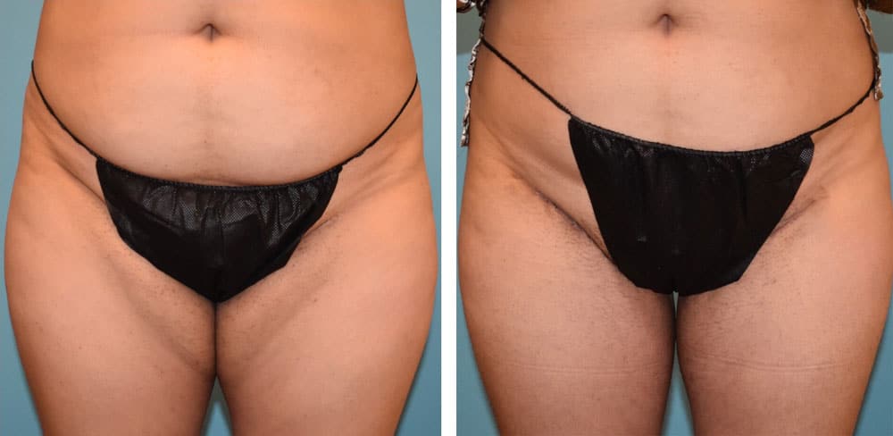 Zeiderman before and after thigh lift procedure