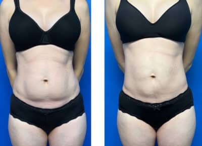 Liposuction Patient – 3