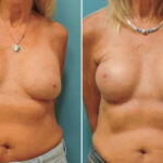 Thumbnail of http://breast-reconstruction-dr-zeiderman-1