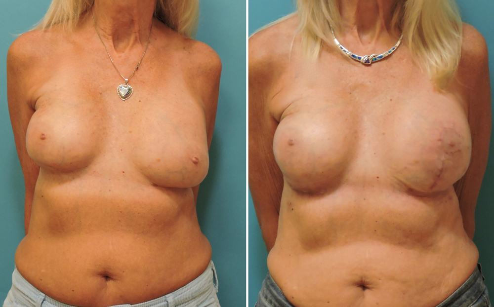 breast-reconstruction-dr-zeiderman-1