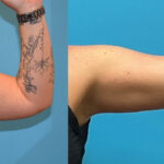 Thumbnail of http://Brachioplasty