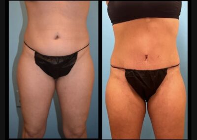 Abdominoplasty Dr Zeiderman 2
