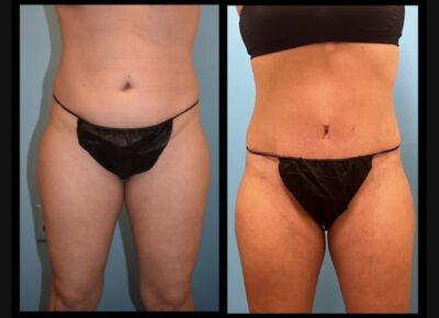 Abdominoplasty Dr Zeiderman 2