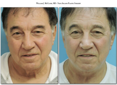 Facelift – Dr. McClure 47