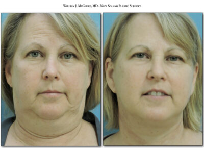 Facelift – Dr. McClure 16