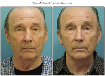 Facelift – Dr. McClure 45