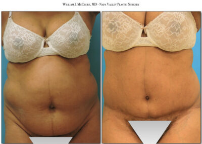 Abdominoplasty – Dr. McClure 6