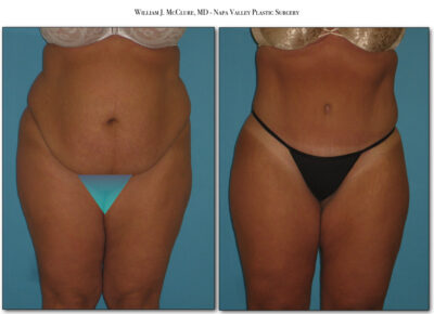 Abdominoplasty – Dr. McClure 2