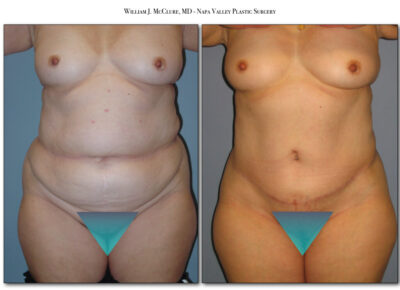 Abdominoplasty – Dr. McClure 9