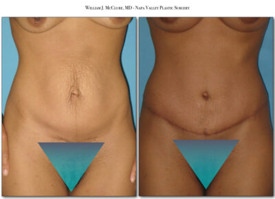 Abdominoplasty – Dr. McClure 11