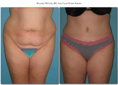 Abdominoplasty – Dr. McClure 12