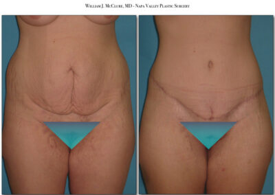 Abdominoplasty – Dr. McClure 13