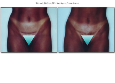 Abdominoplasty – Dr. McClure 14
