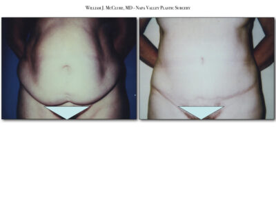 Abdominoplasty – Dr. McClure 15