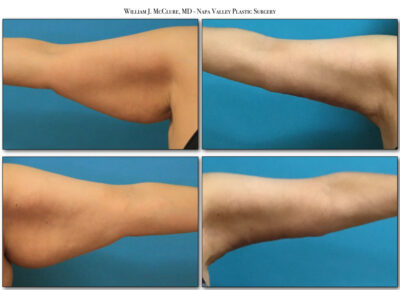 Brachioplasty – Dr. McClure 1
