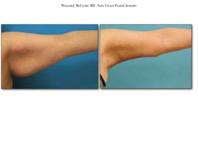 Brachioplasty – Dr. McClure 3