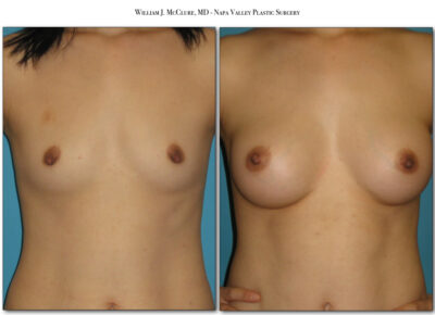 Breast Augmentation – Dr. McClure 4