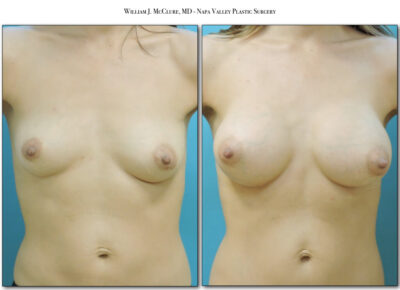 Breast Augmentation – Dr. McClure 8