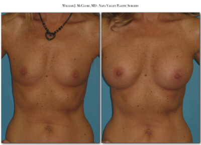 Breast Augmentation – Dr. McClure 10