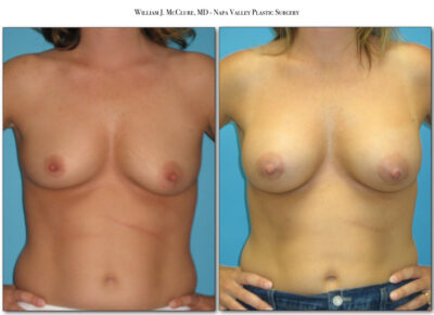 Breast Augmentation – Dr. McClure 11