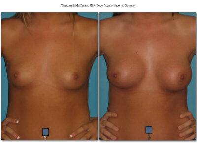 Breast Augmentation – Dr. McClure 12