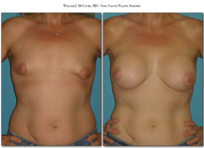 Breast Augmentation – Dr. McClure 14