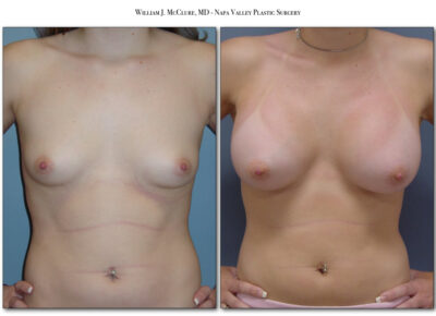 Breast Augmentation – Dr. McClure 15