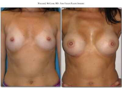 Breast Augmentation – Dr. McClure 17