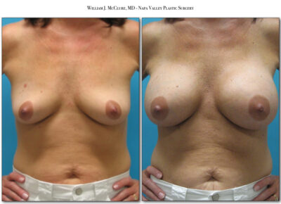 Breast Augmentation – Dr. McClure 19