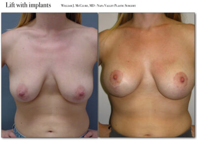 Breast Reduction – Dr. McClure 13