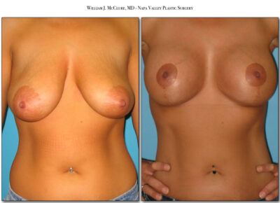 Breast Reduction – Dr. McClure 4