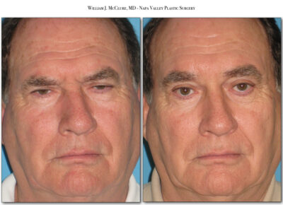 Browlift – Dr. McClure 30