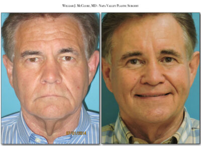 Browlift – Dr. McClure 31