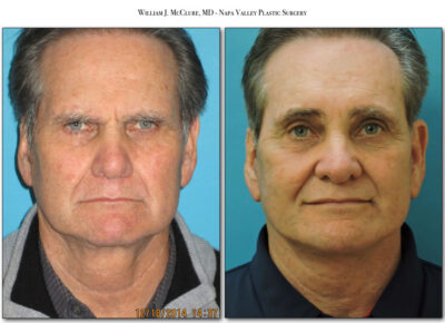 Browlift – Dr. McClure 32