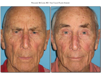Browlift – Dr. McClure 33
