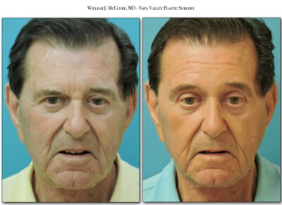 Browlift – Dr. McClure 35