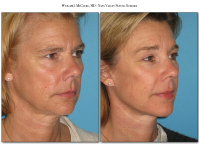 Browlift – Dr. McClure 1
