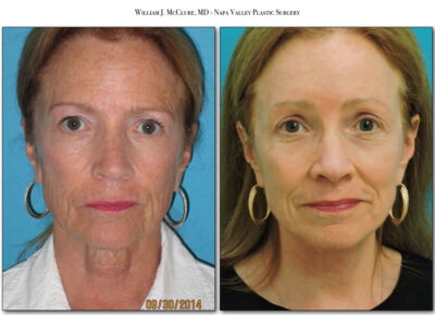 Browlift – Dr. McClure 13