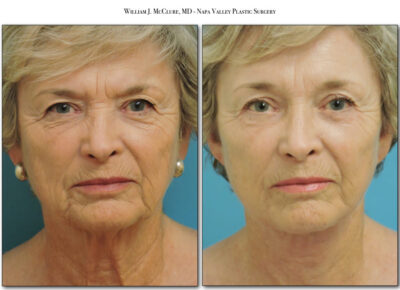 Browlift – Dr. McClure 6