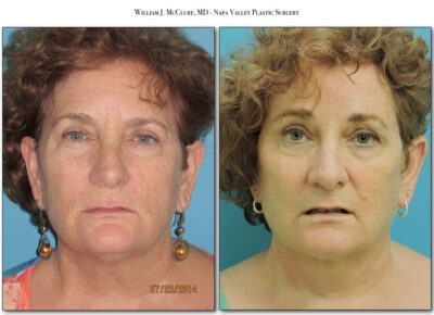 Browlift – Dr. McClure 17