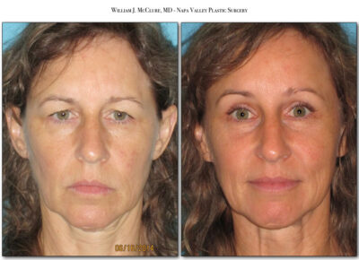Browlift – Dr. McClure 22