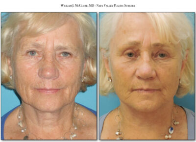 Browlift – Dr. McClure 23
