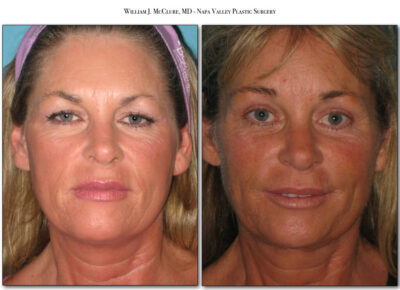 Browlift – Dr. McClure 24