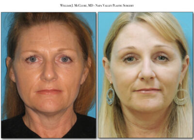 Browlift – Dr. McClure 25