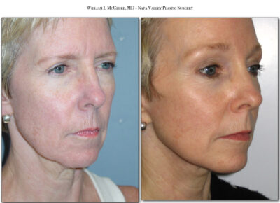 Browlift – Dr. McClure 28